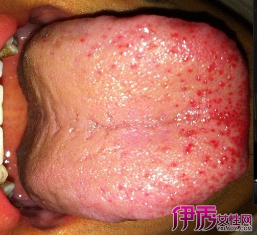 艾滋病舌头小红点图片图片