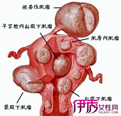 引产后子宫下垂的图片图片