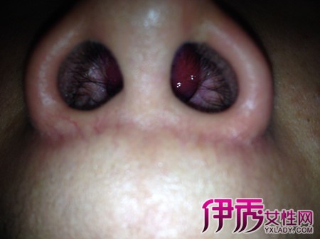 【图】鼻子里面有个红色肉球 揭秘其多种百变病因