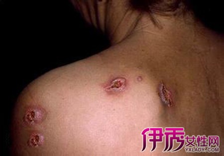 女性梅毒晚期图片