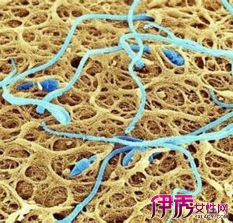 阴囊角质血管瘤图片