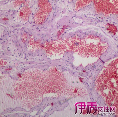 阴囊血管瘤图图片