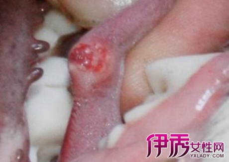 舌头上有痘痘图片图片