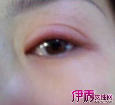【图】眼睛过敏红肿痒怎么办 九个方法呵护眼睛红肿