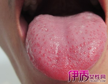 【图】舌头毛状白斑图片展示 这种病有什么临床表现?