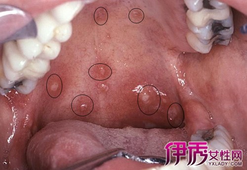 【圖】艾滋病口腔表現症狀有哪些 6大表現是早期診斷關鍵症狀