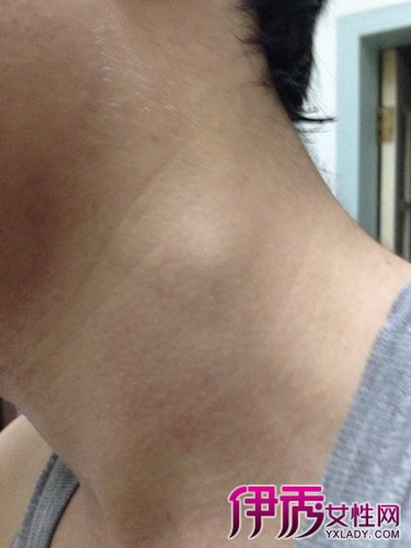 柔和的什么是肿块的图片