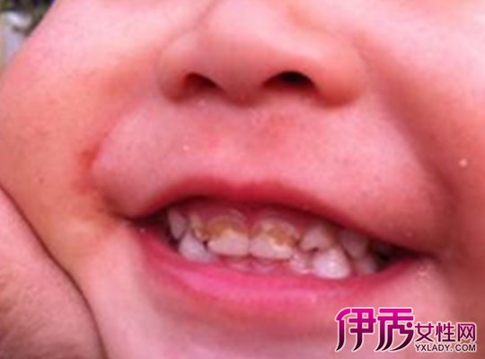 【图】牙齿根部腐蚀图片大全 教你如何保护牙