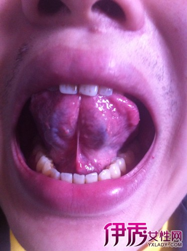 舌头下边血管发紫又粗图片