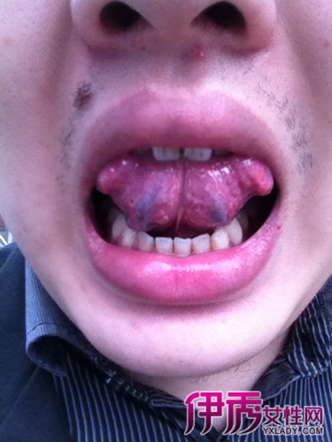 舌头底下血管瘤图片图片
