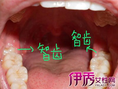 【图】智齿横着长图片展示 以下两种情况需拔掉智齿