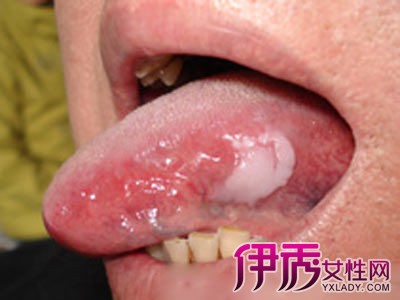 【图】舌头白斑图片展示 了解常见的临床表现及预防方法
