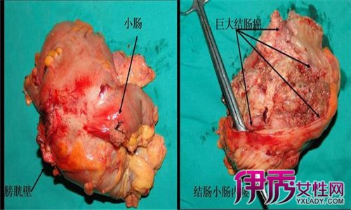 乙状结肠腺瘤图片图片