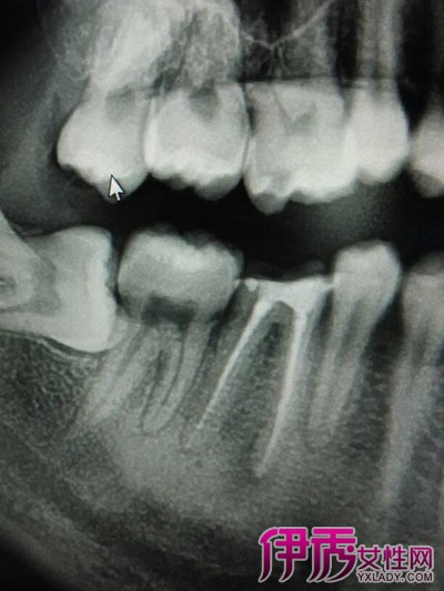 【图】牙根尖囊肿到底是什么病 深度揭秘牙尖