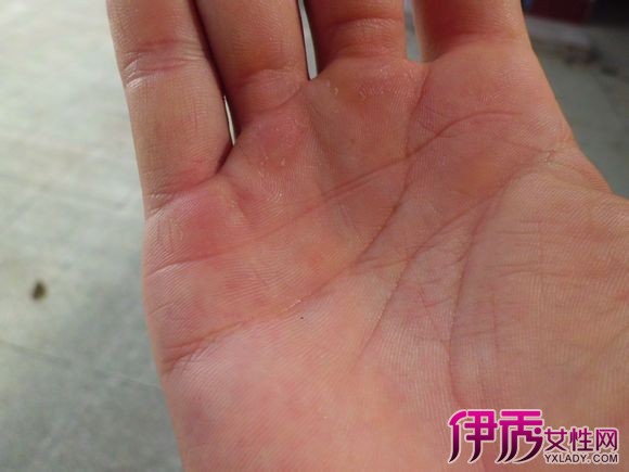 【图】手指肌肉萎缩怎么治 3种方法让你摆脱肌肉萎缩