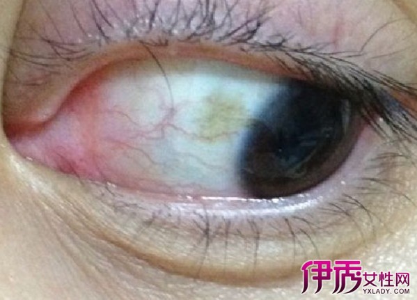【图】眼睛里有黄斑图片展示 专家解读长黄斑原因