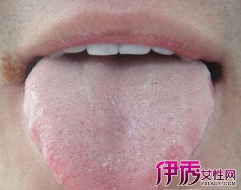 【图】舌头边缘呈锯齿状疼怎么回事 因脾虚寒