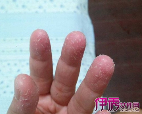 【图】小孩手指掉皮是什么原因 该怎么去治疗