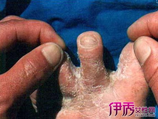 角化型手足癣的症状图片