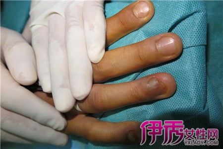 【图】手指毛细血管破裂怎么办 其五种病因大揭秘