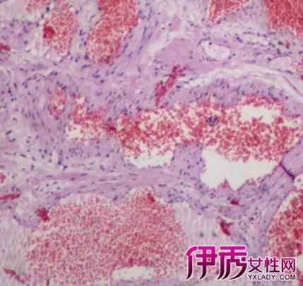阴囊血管瘤图图片