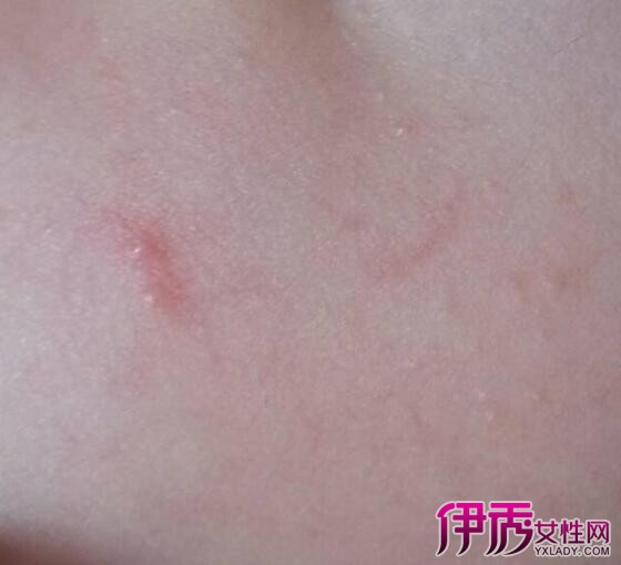 【图】脸上好多红点点怎么办 分析引起红点的