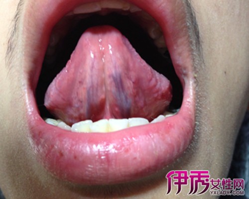正常舌下血管图片图片