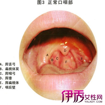 慢性咽喉炎怎麼治好