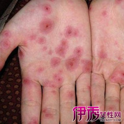 【图】梅毒疹会有脓吗 梅毒疹的5大症状介绍