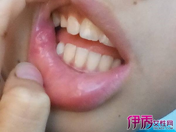 不但影響美觀,而且妨礙吃東西;像上火,口腔潰瘍,唇皰疹,疲勞,抵抗力低