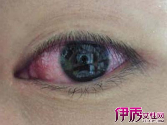 【图】眼睛发红充血怎么办 该如何治疗
