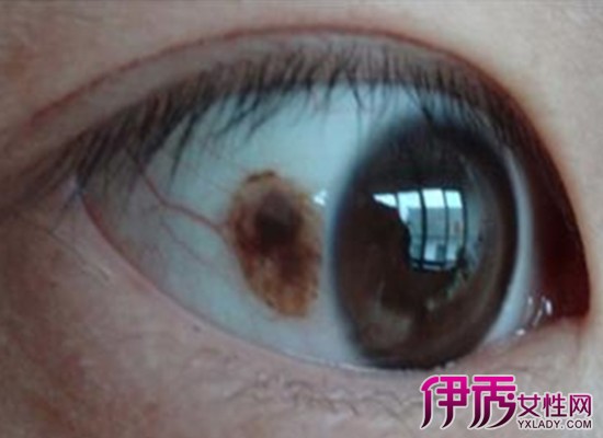 【图】眼睛黄斑病变严重吗 分享黄斑病的治疗