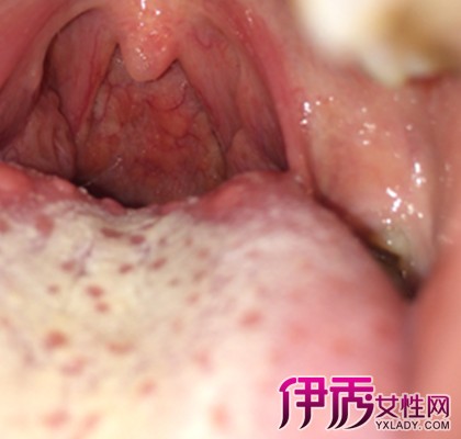 咽炎舌根有疙瘩图片