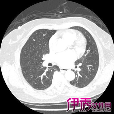 【图】介绍左肺下叶小结节病情 建议及时就医