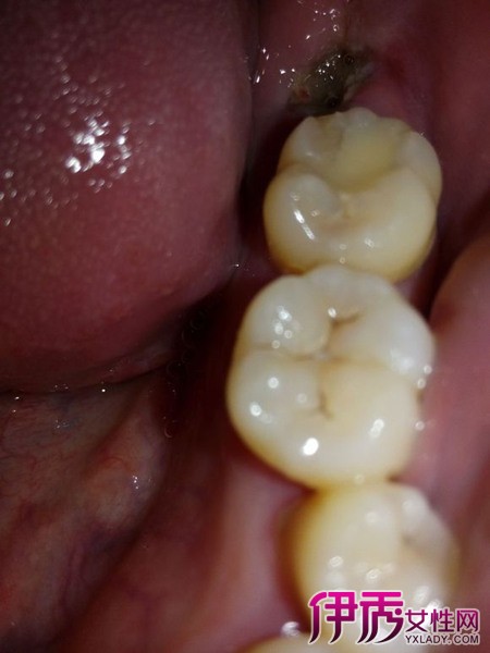 拔完牙干槽症的图片图片