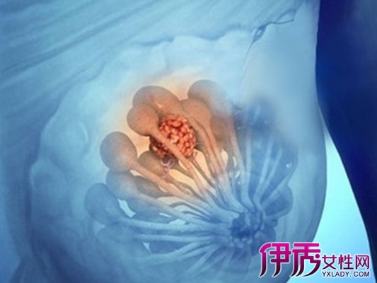 乳腺結節可不可以消除