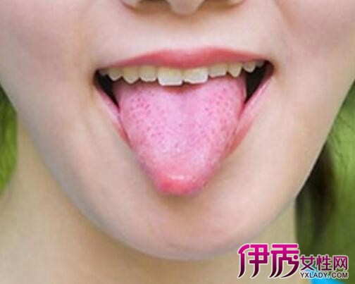 【舌头上长泡的原因】【图】舌头上长泡的原因
