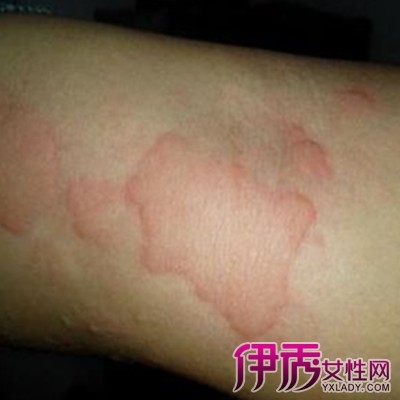 【治疗人工荨麻疹的偏方】【图】治疗人工荨麻