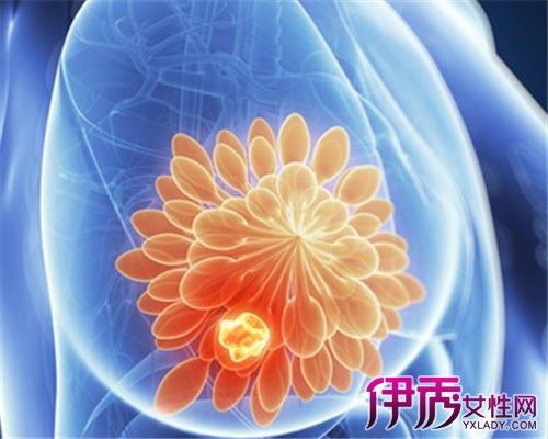 【乳腺癌早期治疗方法】【图】乳腺癌早期治疗
