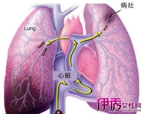 【肝癌早期治疗】【图】肝癌早期治疗方法有哪