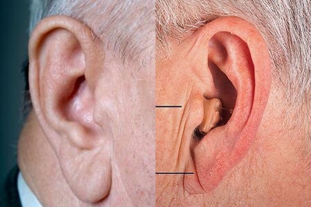 【图】耳垂有折痕 不可忽视的健康隐患