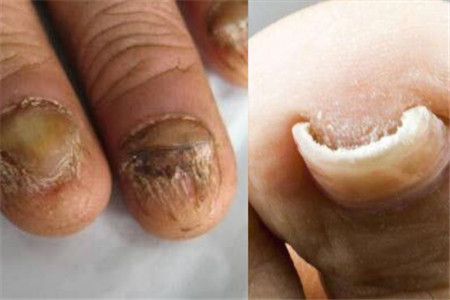 关于手指甲的各种病症图片