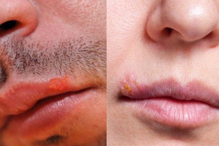 【图】嘴唇长疱疹是什么原因 让你下一次对此增加防范