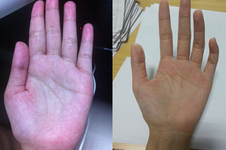 肝掌和正常手掌的区别图片