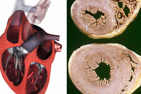 【图】左心室肥大能治愈吗 两大妙招让你巧妙解决