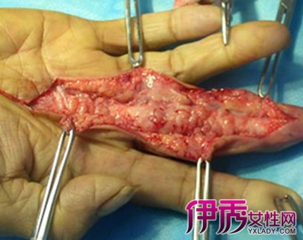 腱鞘囊肿内部图片图片