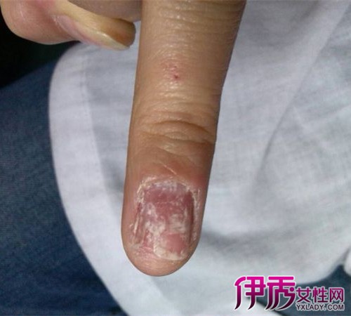 【图】手指甲上面脱皮怎么回事 全面剖析症状及原因